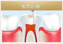 根管治療